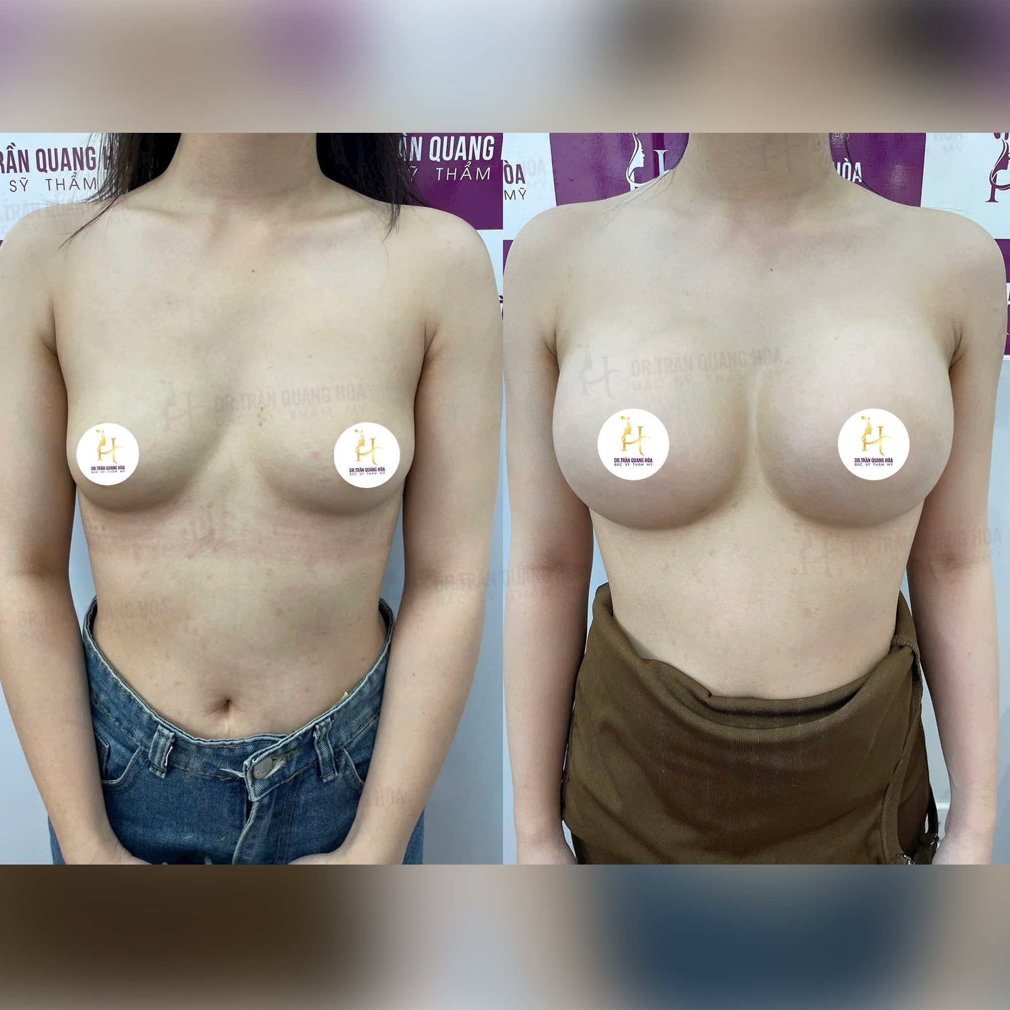 Kết quả trước và sau nâng ngực túi Mentor Xtra size 325cc, form ngực cao bay, thoát dáng xệ