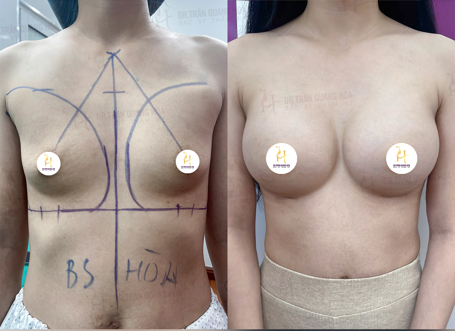 Review nâng ngực size 335cc Bác sĩ Hòa chưa sinh con sexy